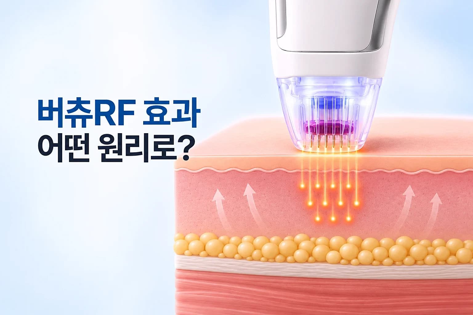 미세 니들 핸드피스가 진피에 고주파 열을 전달하는 단면을 담은 버츄RF 효과 썸네일