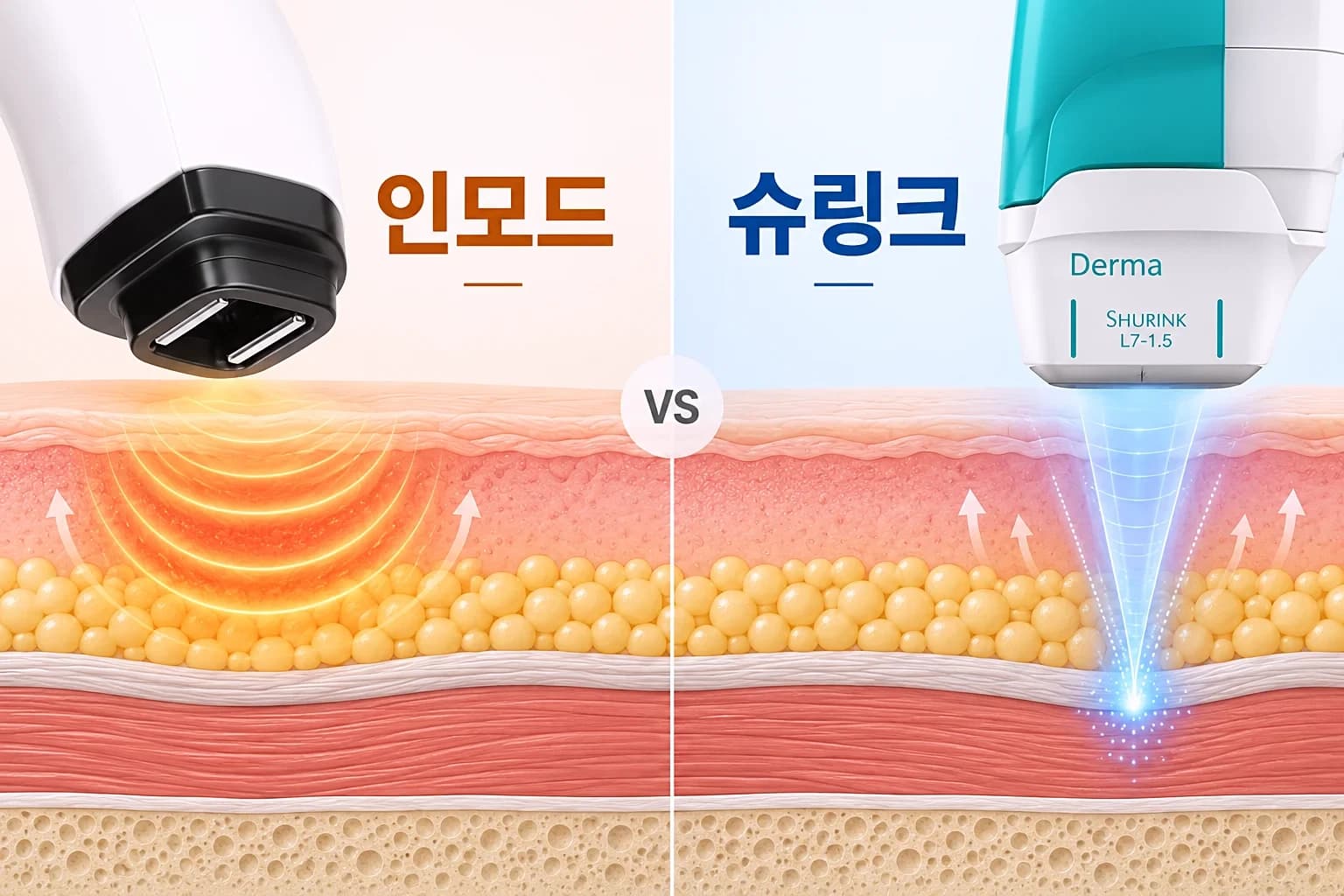 인모드 고주파와 슈링크 초음파 핸드피스가 서로 다른 피부층에 작용하는 모습을 비교한 썸네일