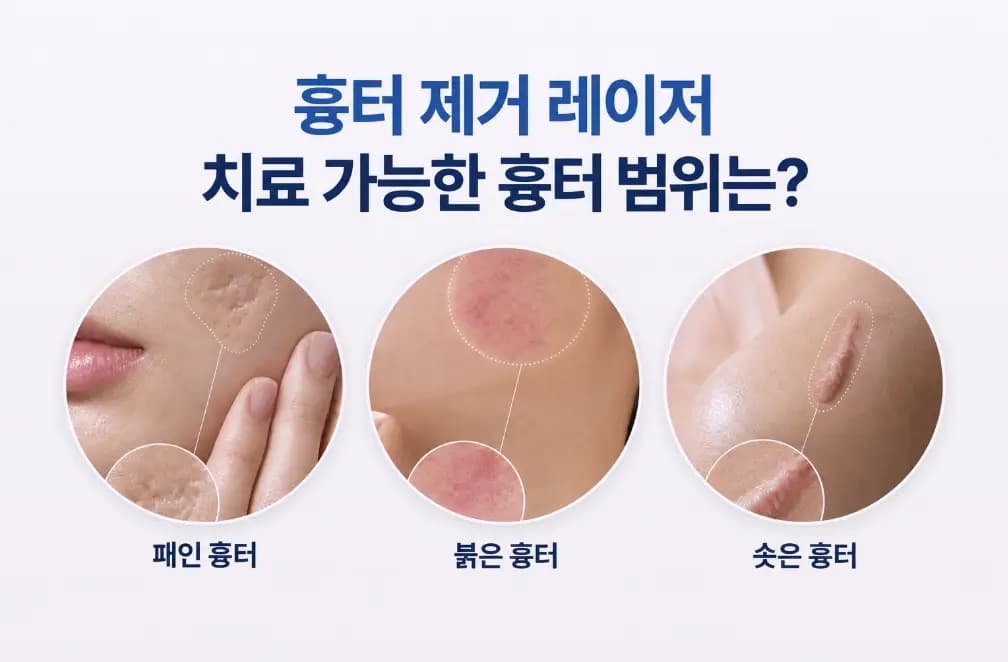 패인 흉터와 붉은 흉터, 솟은 흉터의 피부 표면 차이를 비교한 흉터 제거 레이저 썸네일